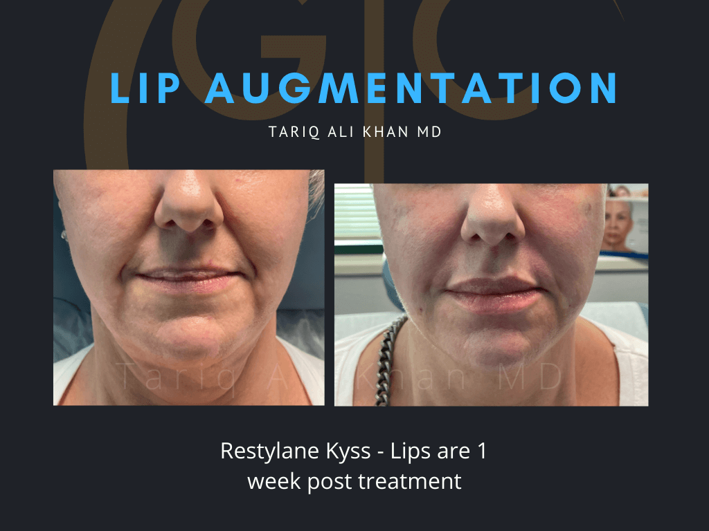 Gentle Care Laser Tustin Before and After picture - Lip Augmentation